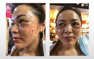 新疆玉雪尔祛斑过程效果如何？